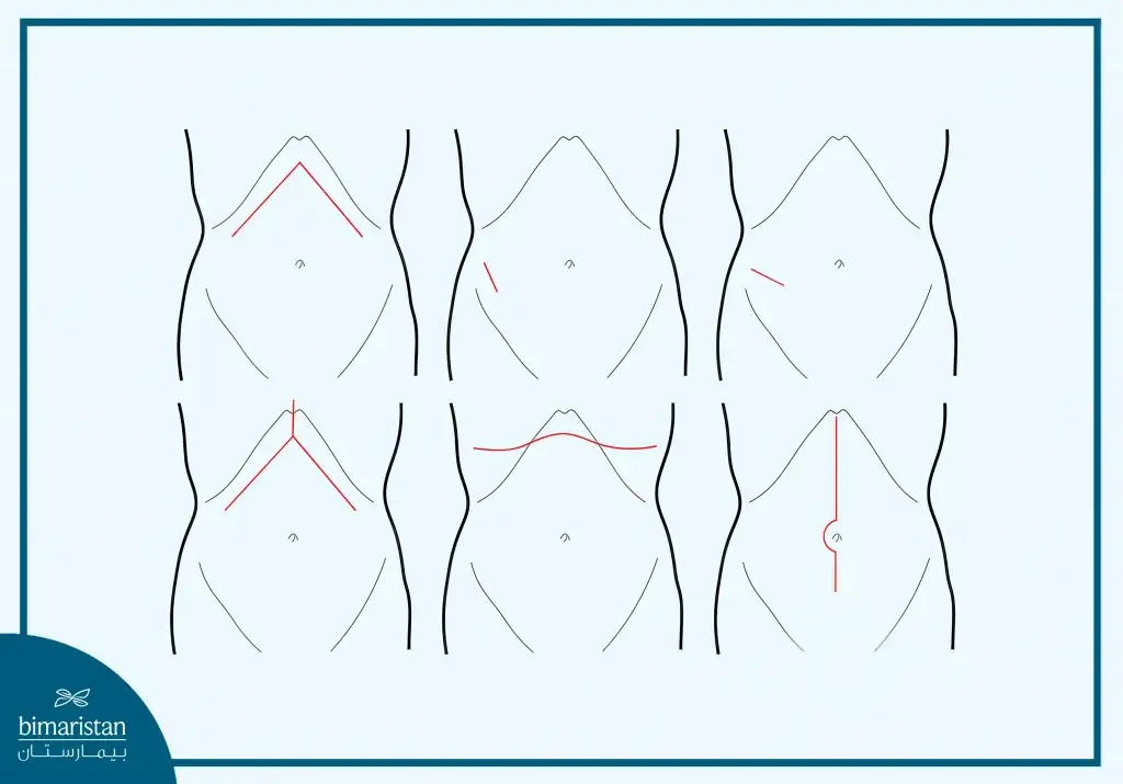 An Illustration Depicting The Different Shapes Of Surgical Incisions Used In Liver Transplant For Children