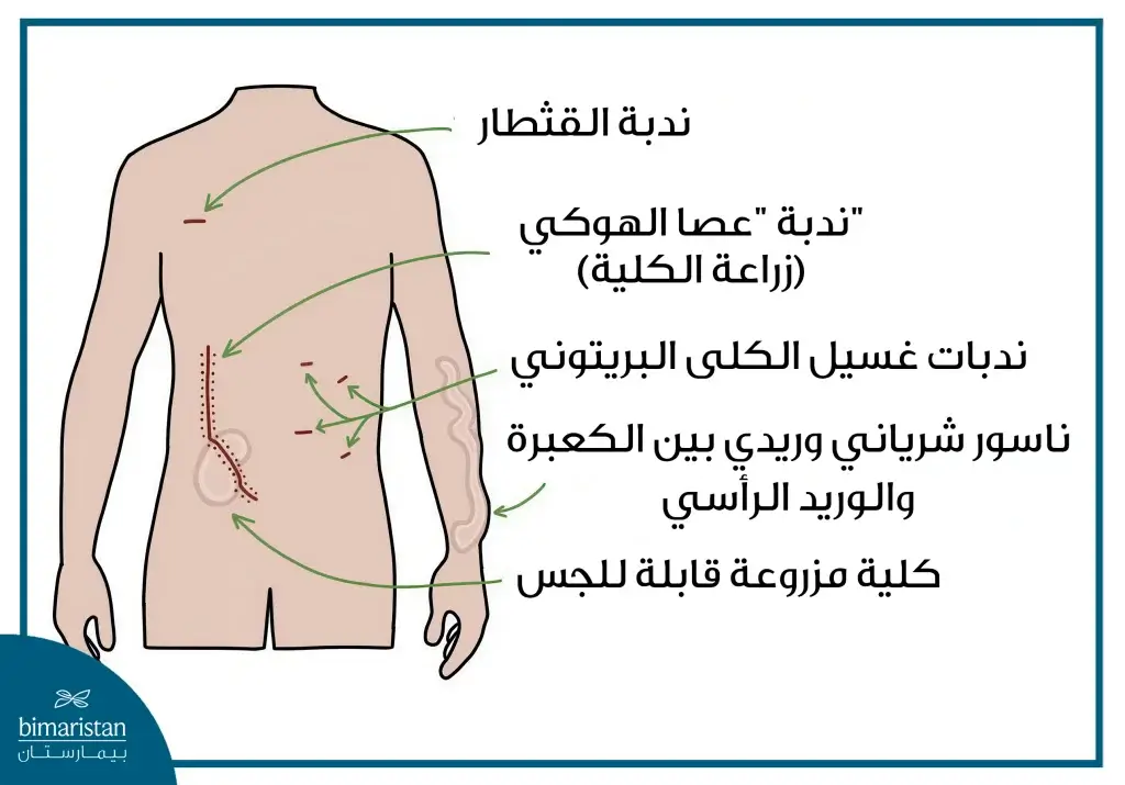 صورة توضح الشقوق الجراحية والعلامات عند مريض زراعة الكلى في تركيا