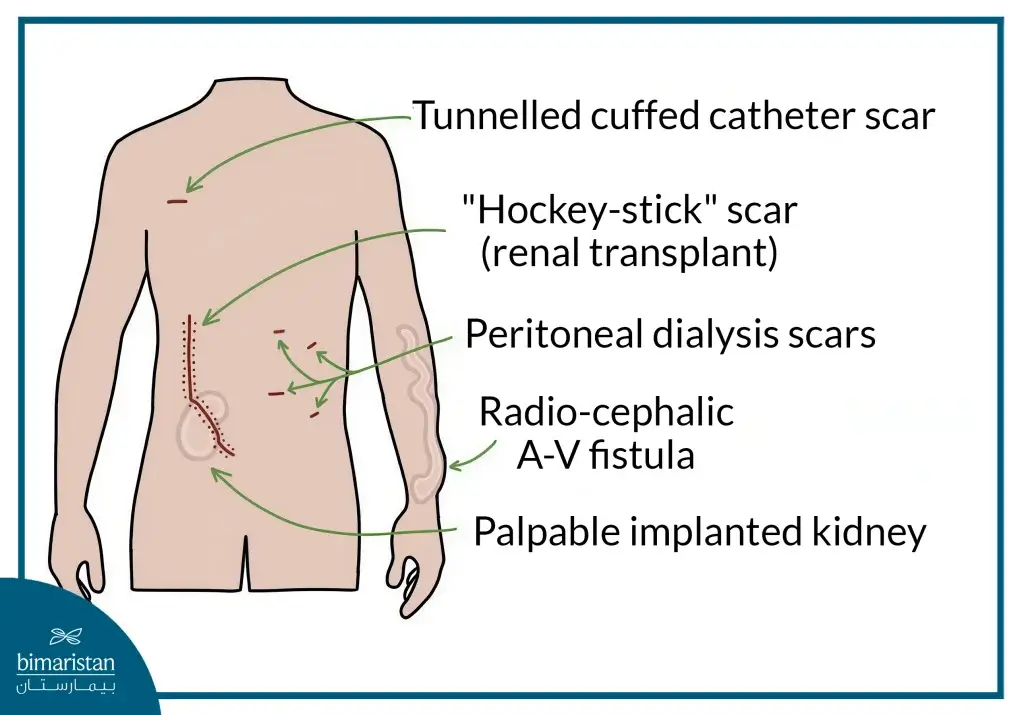 Kidney Transplant In Turkey: A New Hope For Kidney Failure Patients 4 An Image Showing Surgical Incisions And Markings Made On The Body Of A Kidney Transplant Patient In Turkey
