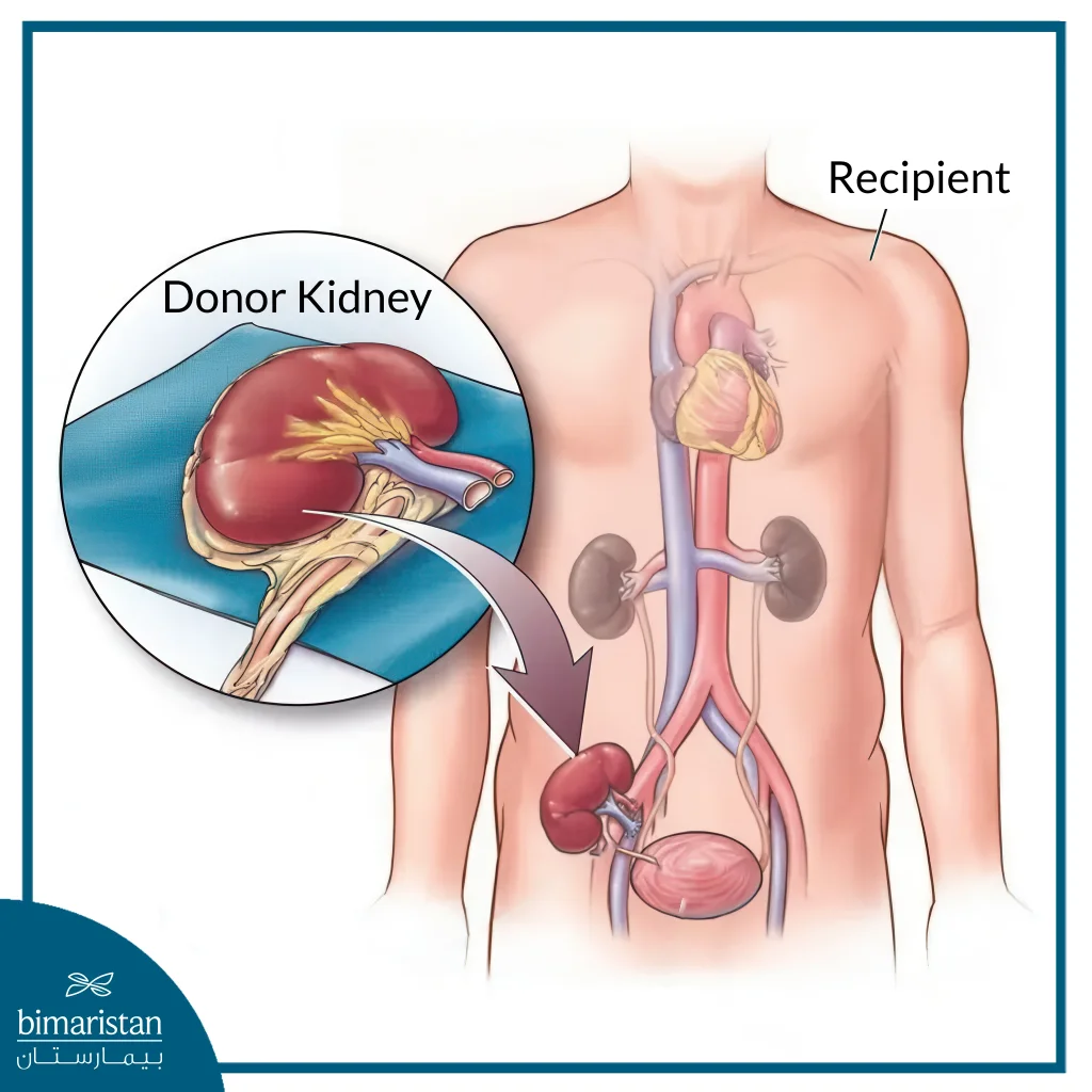 Pediatric Kidney Transplant: Causes, Procedure, And Outcomes 3 Pediatric Kidney Transplant