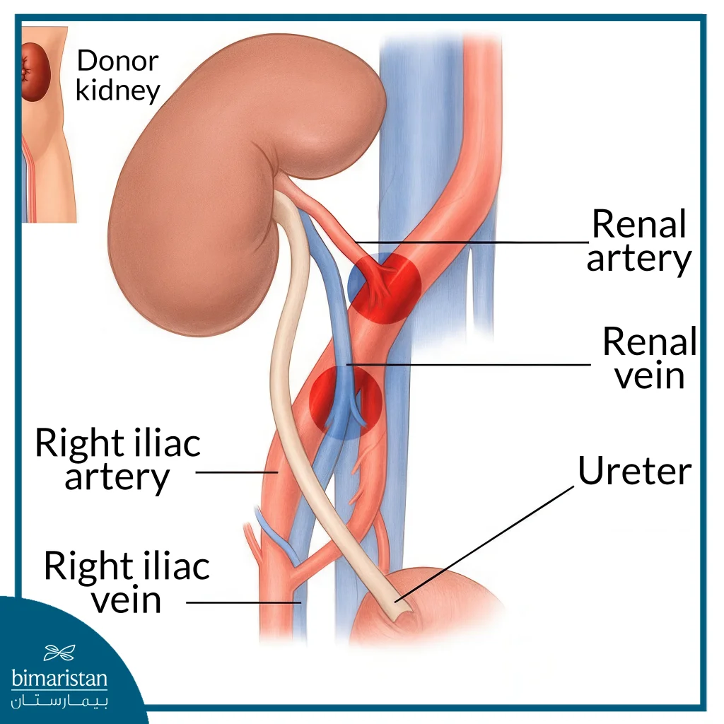 Pediatric Kidney Transplant: Causes, Procedure, And Outcomes 4 Image Showing Ligation In A Pediatric Kidney Transplant