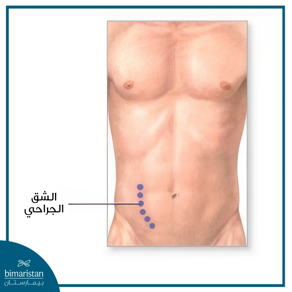 صورة توضح الشق الجراحي في عملية زراعة الكلى للأطفال