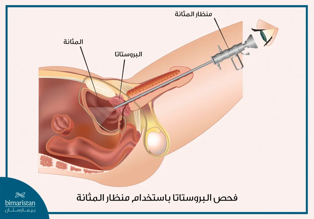 آلية تنظير المثانة لتشخيص سلس البول عند الرجال