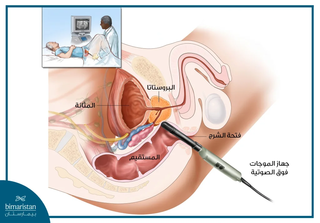 ايكو المستقيم لتقييم حالة البروستاتا
