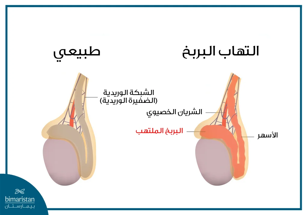التهاب البربخ أحد أسباب ضعف الحيوانات المنوية