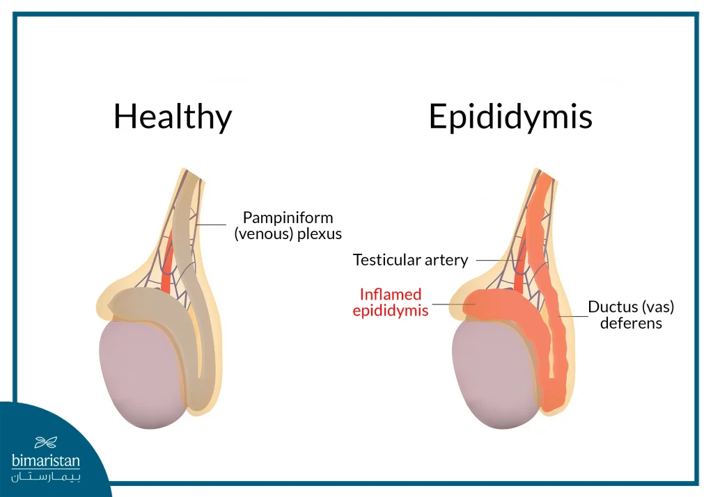 Epididymitis Is One Of The Causes Of Weak Sperm