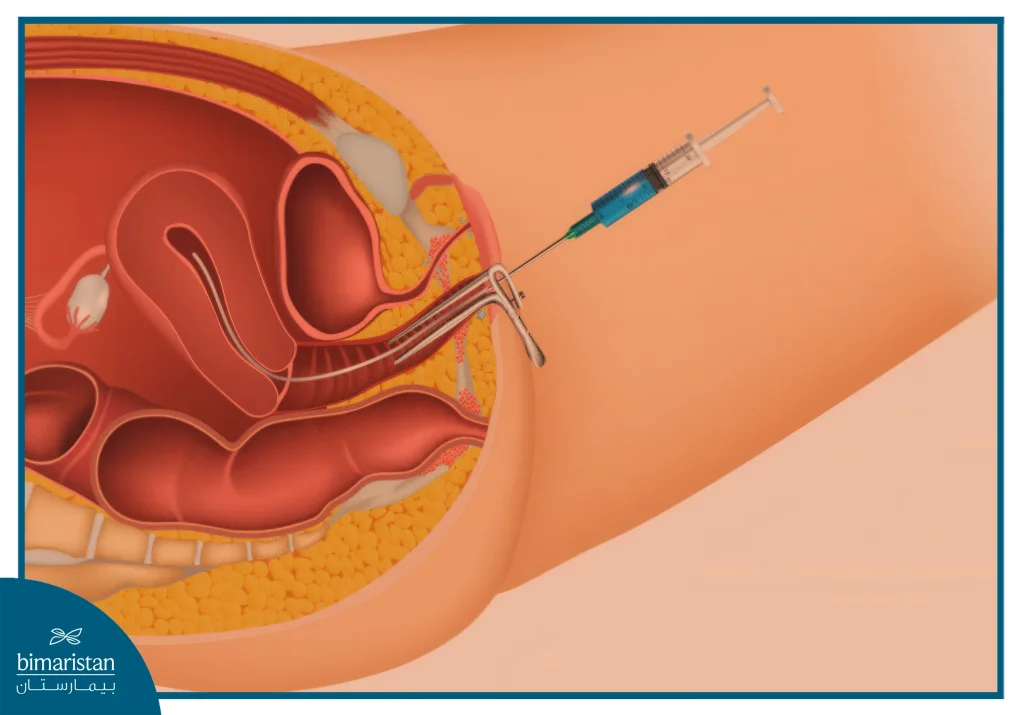 Intrauterine Insemination (Iui) Is One Of The Treatments For Weak Sperm