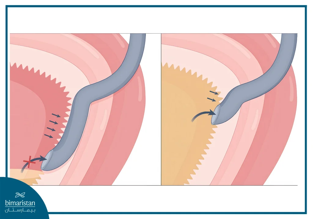 Ureteral Reimplantation As A Surgical Treatment Of Vesicoureteral Reflux In Children