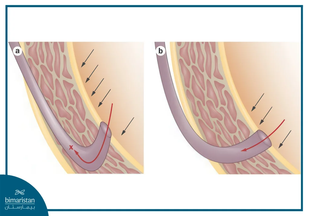 A Picture Showing The Difference Between A Healthy Ureter And A Ureter That Allows Urine Reflux
