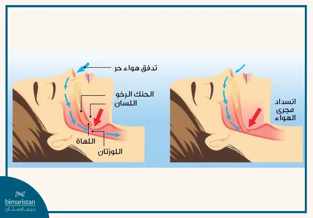 توقف التنفس الانسدادي أثناء النوم (Osa)