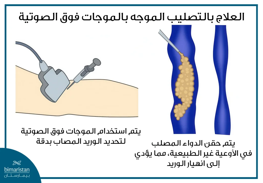 علاج الدوالي بالحقن (التصليب) 5 صورة توضح علاج الدوالي بالحقن الموجه بالموجات فوق الصوتية