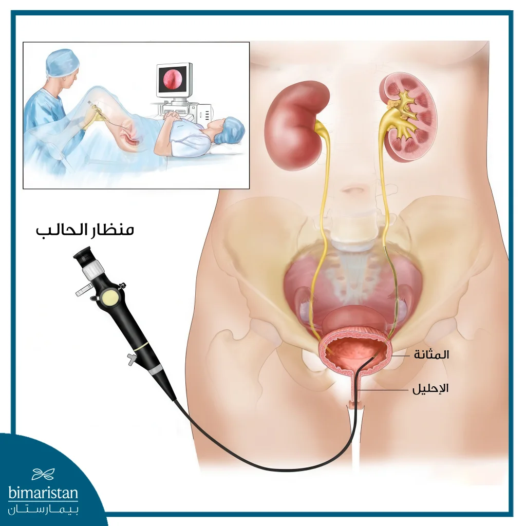 صورة توضيحية لتنظير المثانة والحالب