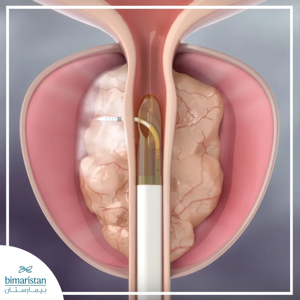 علاج تضخم البروستاتا بدون عملية: أحدث الخيارات الطبية والدوائية 2 تقنية الرزيوم لعلاج تضخم البروستات بدون عملية