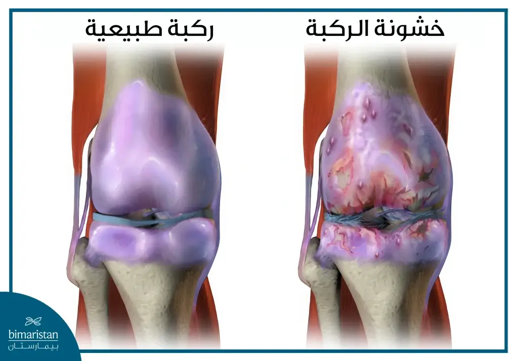 الفرق بين خشونة الركبة والركبة الطبيعية