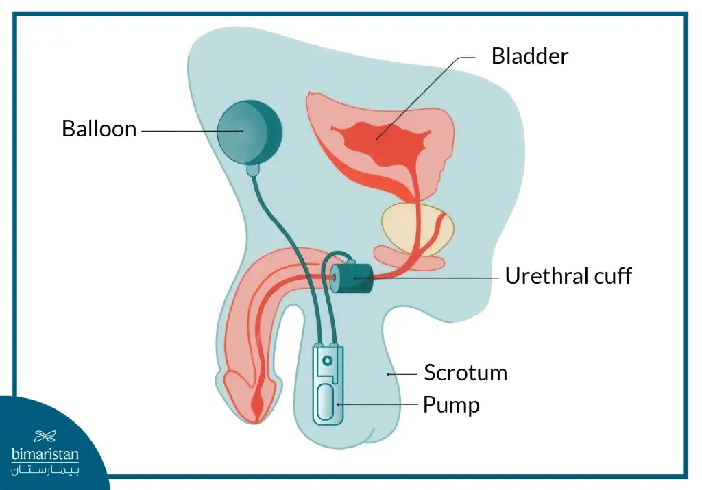 Artificial Sphincter Implants For Male Urinary Incontinence Surgery To Treat Incontinence And Improve Patients' Quality Of Life