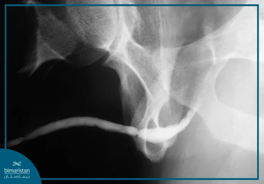 Surgical Urethral Stricture Treatment: Causes, Symptoms &Amp; Options 2 Radiograph Showing A Clear Narrowing Of The Urethra In Surgical Urethral Stricture Treatment.