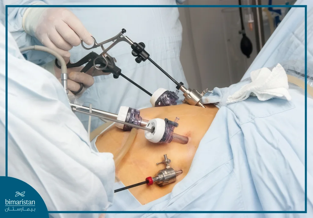 Laparoscopic Varicocele Surgery
