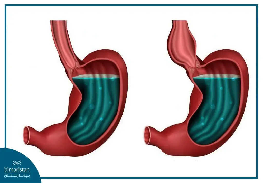 صورة تكشف بوضوح الفرق بين المعدة الطبيعية والإكالازيا