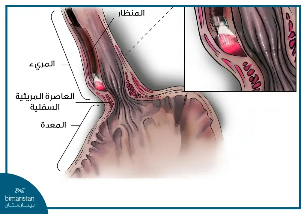 صورة توضح تقنية استخدام المنظار لعلاج الإكالازيا بفعالية