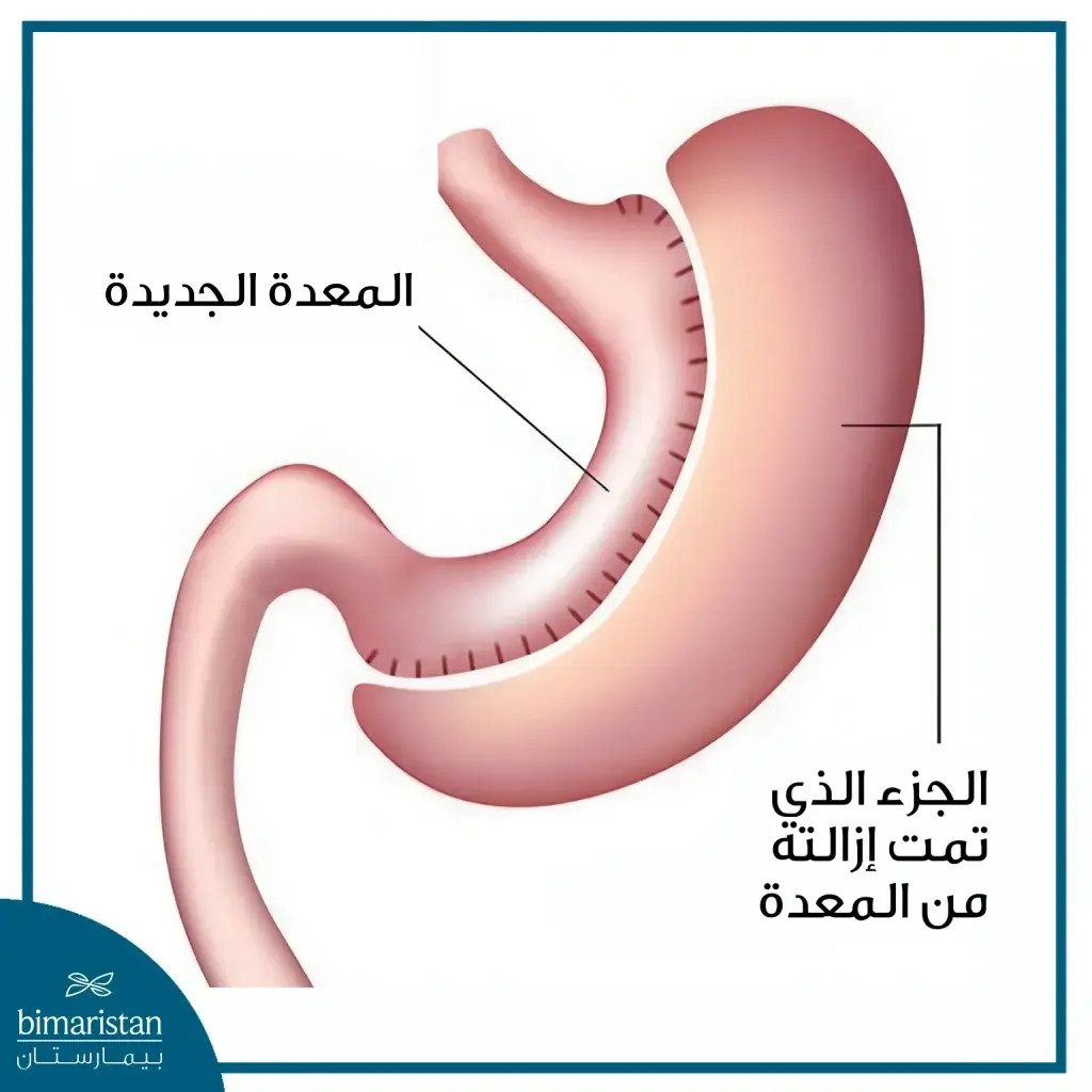 شكل المعدة بعد عملية التكميم