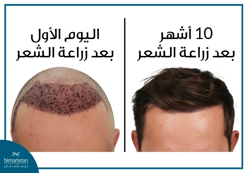 نتائج زراعة الشعر خلال 10 أشهر 
