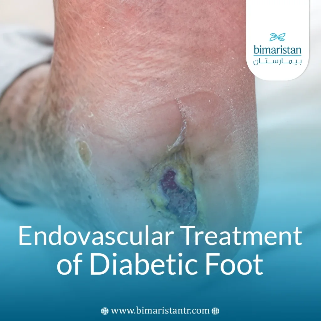 Endovascular Treatment Of Diabetic Foot