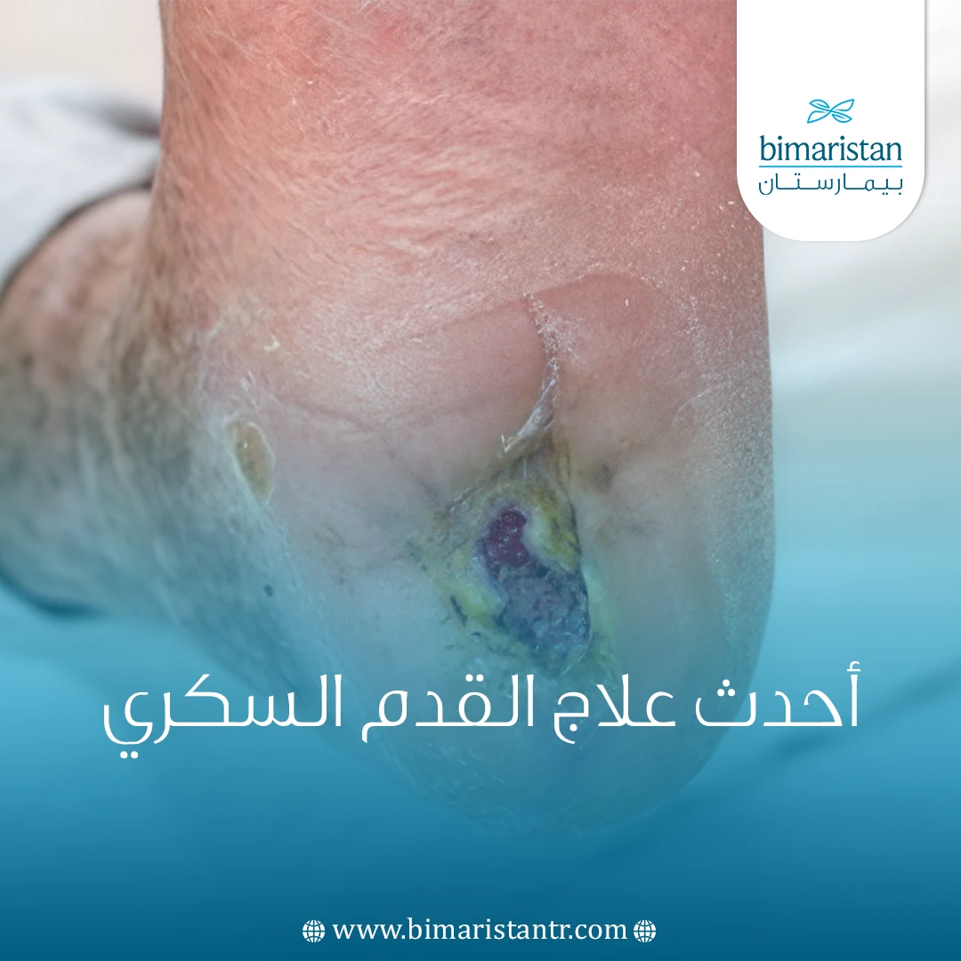 أحدث علاج القدم السكري