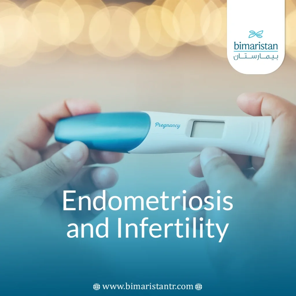 Endometriosis And Infertility