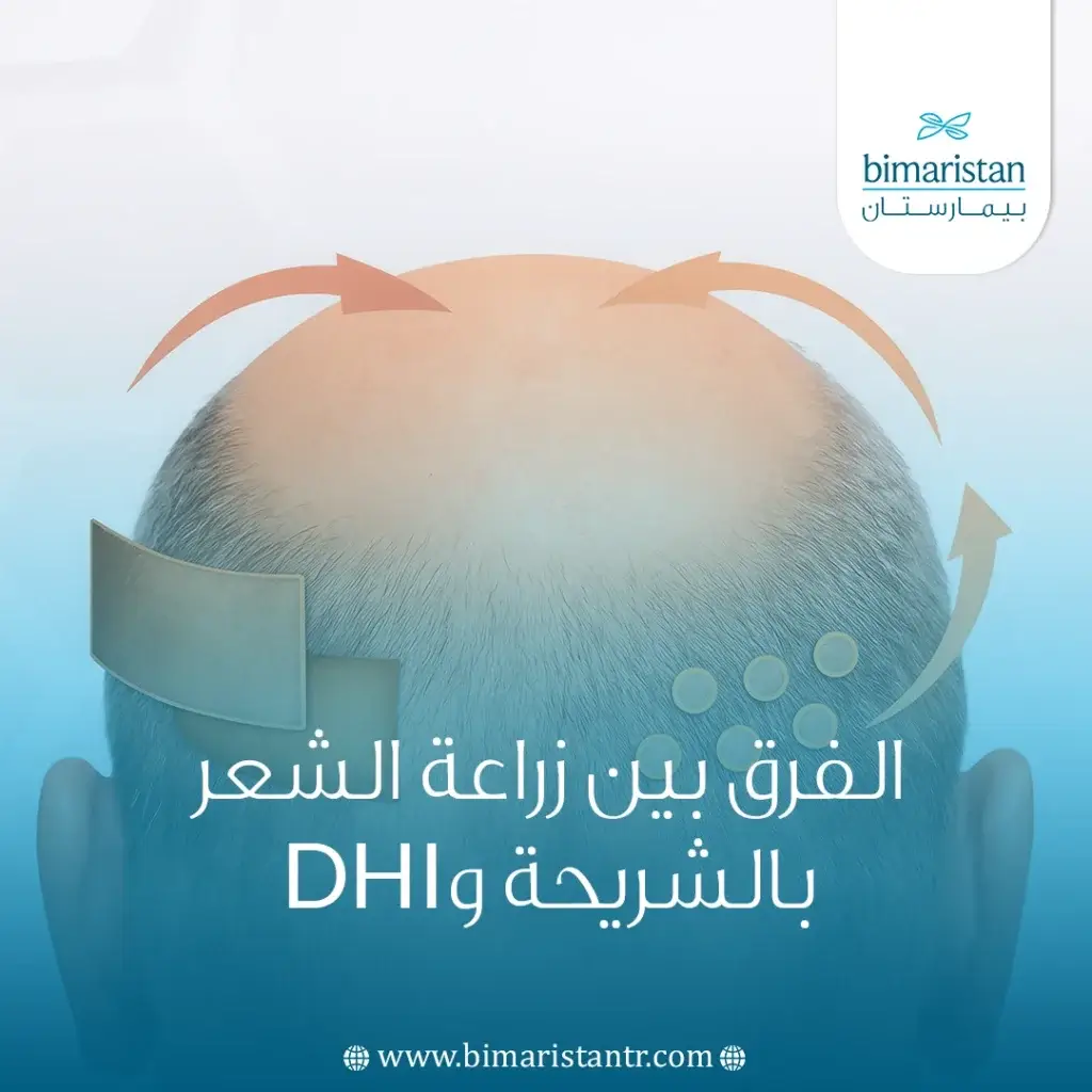 الفرق بين زراعة الشعر بالشريحة وDhi