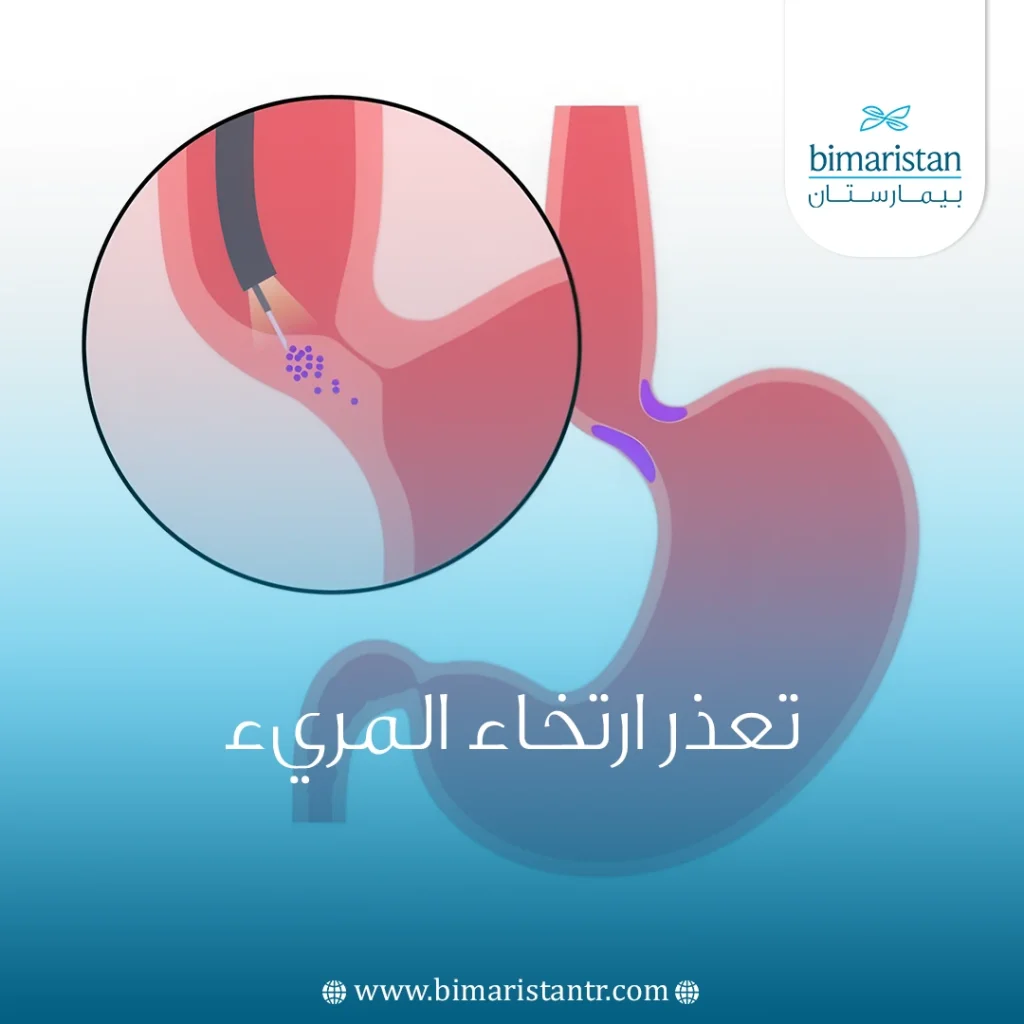 تعذر ارتخاء المريء