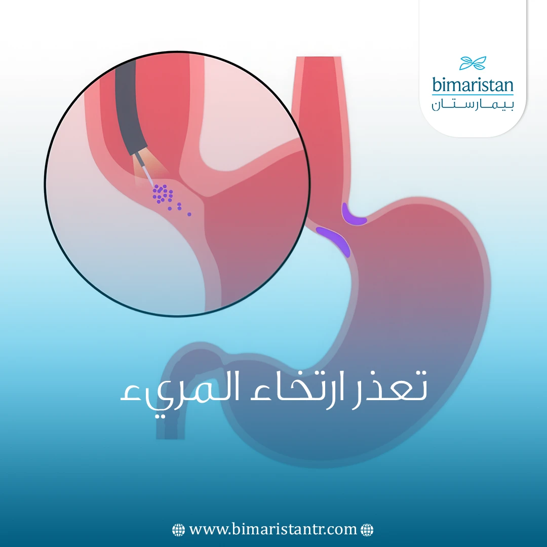 تعذر ارتخاء المريء