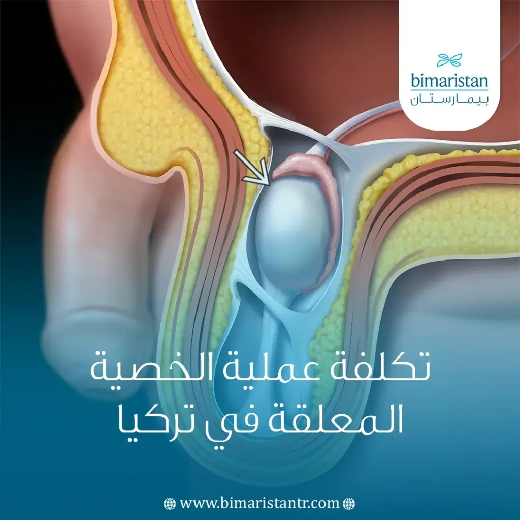 تكلفة عملية الخصية المعلقة في تركيا