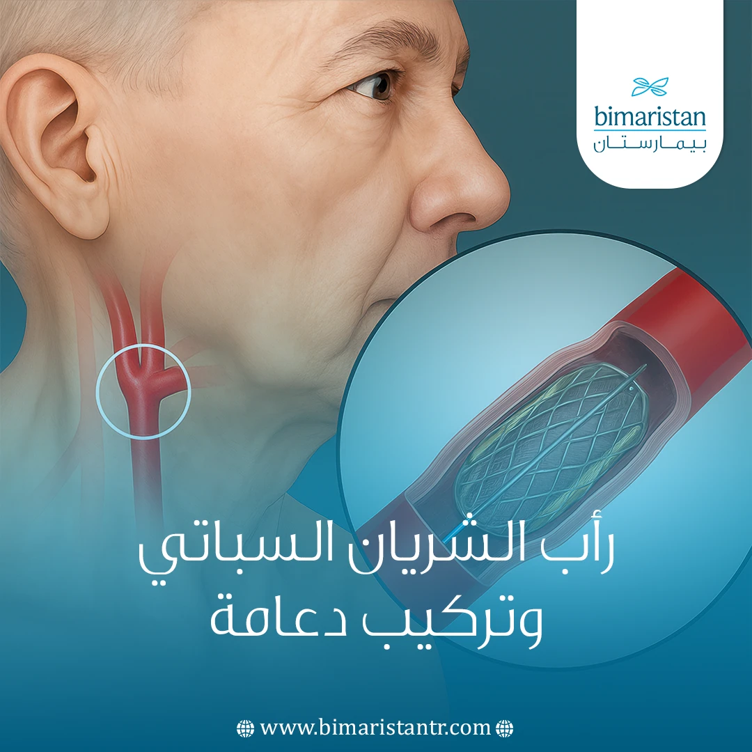 رأب الشريان السباتي وتركيب دعامة