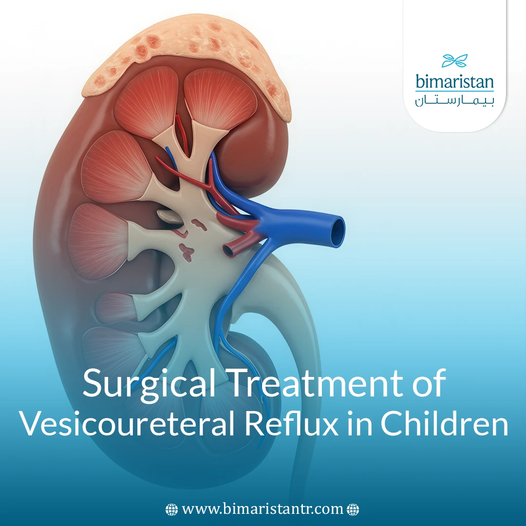 Surgical Treatment Of Vesicoureteral Reflux In Children