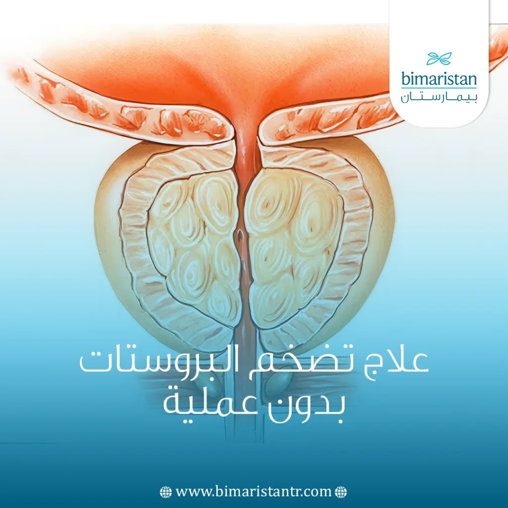 علاج تضخم البروستاتا بدون عملية