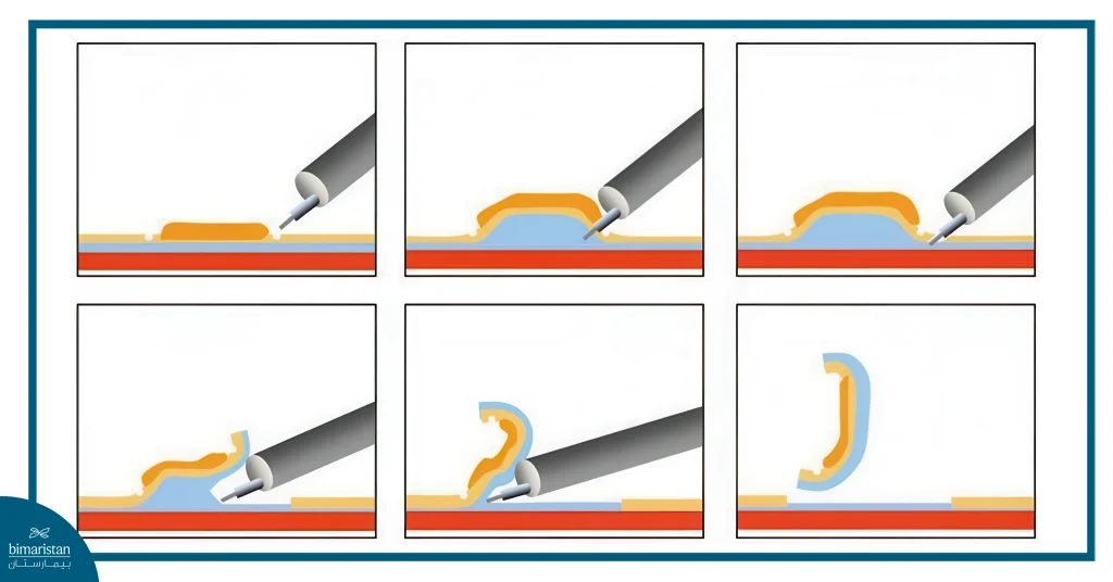 Endoscopic Mucosal Resection