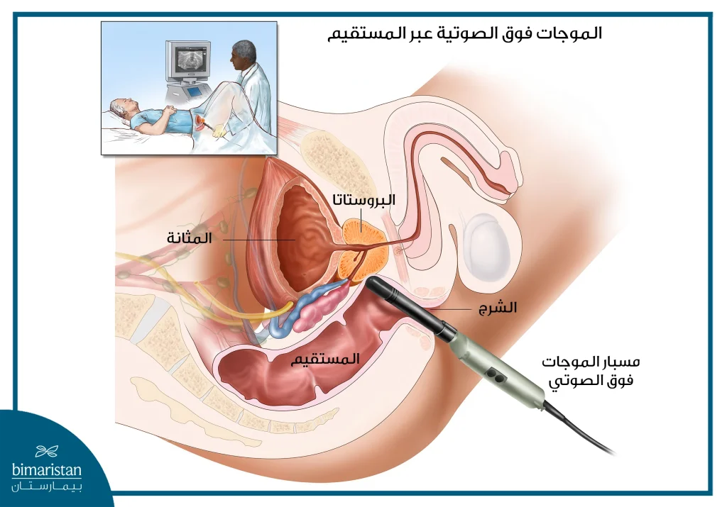 التصوير بالأمواج فوق الصوتية أحد طرق تشخيص تضخم البروستاتا الحميد