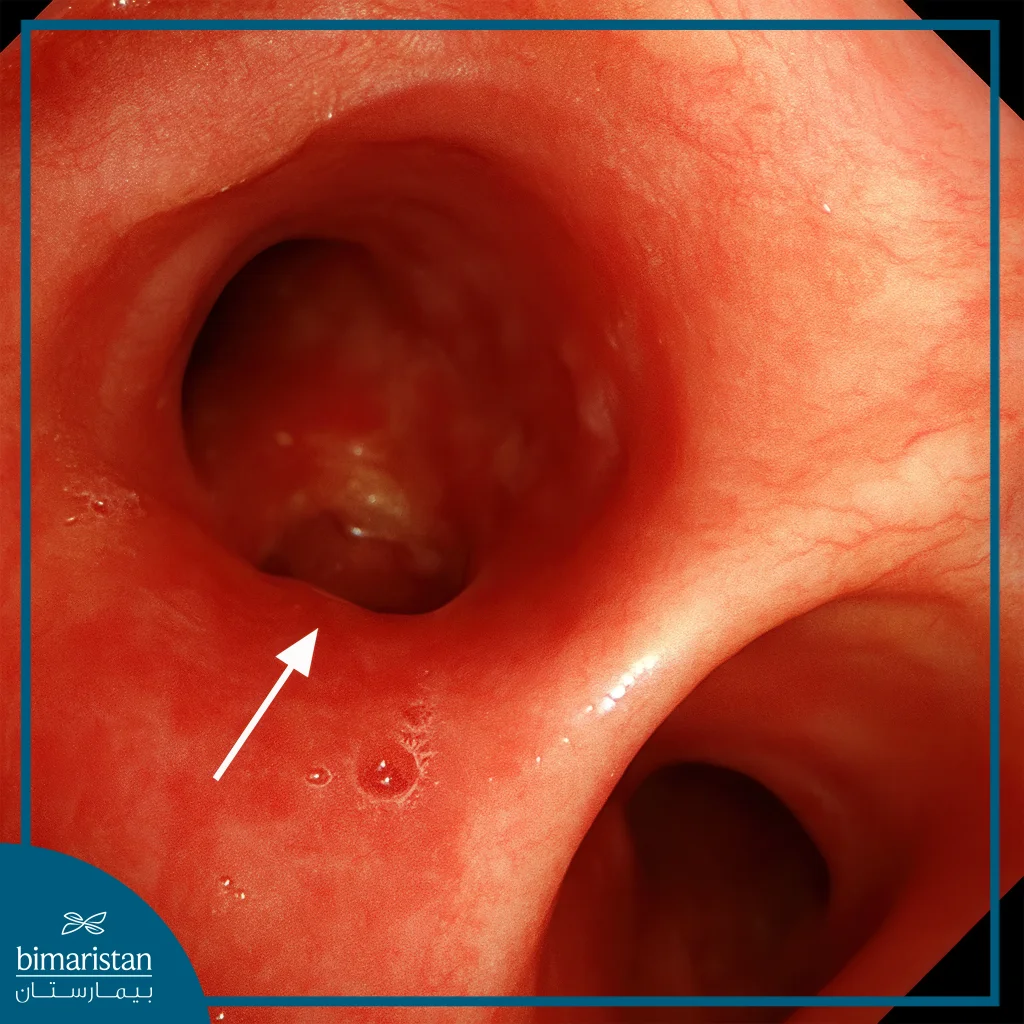 Esophagogastroduodenoscopy Showing The Opening Of An Esophagobronchial Fistula