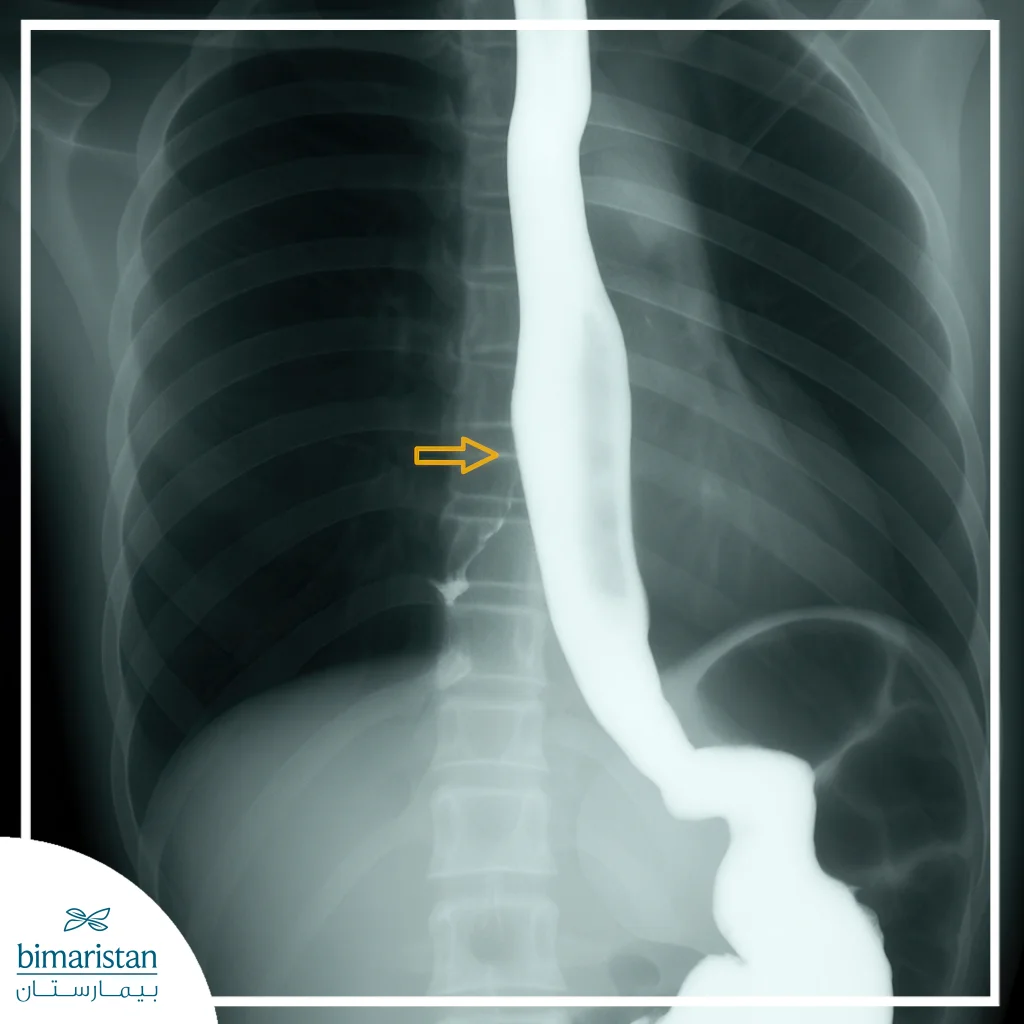 X-Ray Image Showing Leakage Of Shadowy Material From The Esophagus Into The Trachea Through An Esophagobronchial Fistula