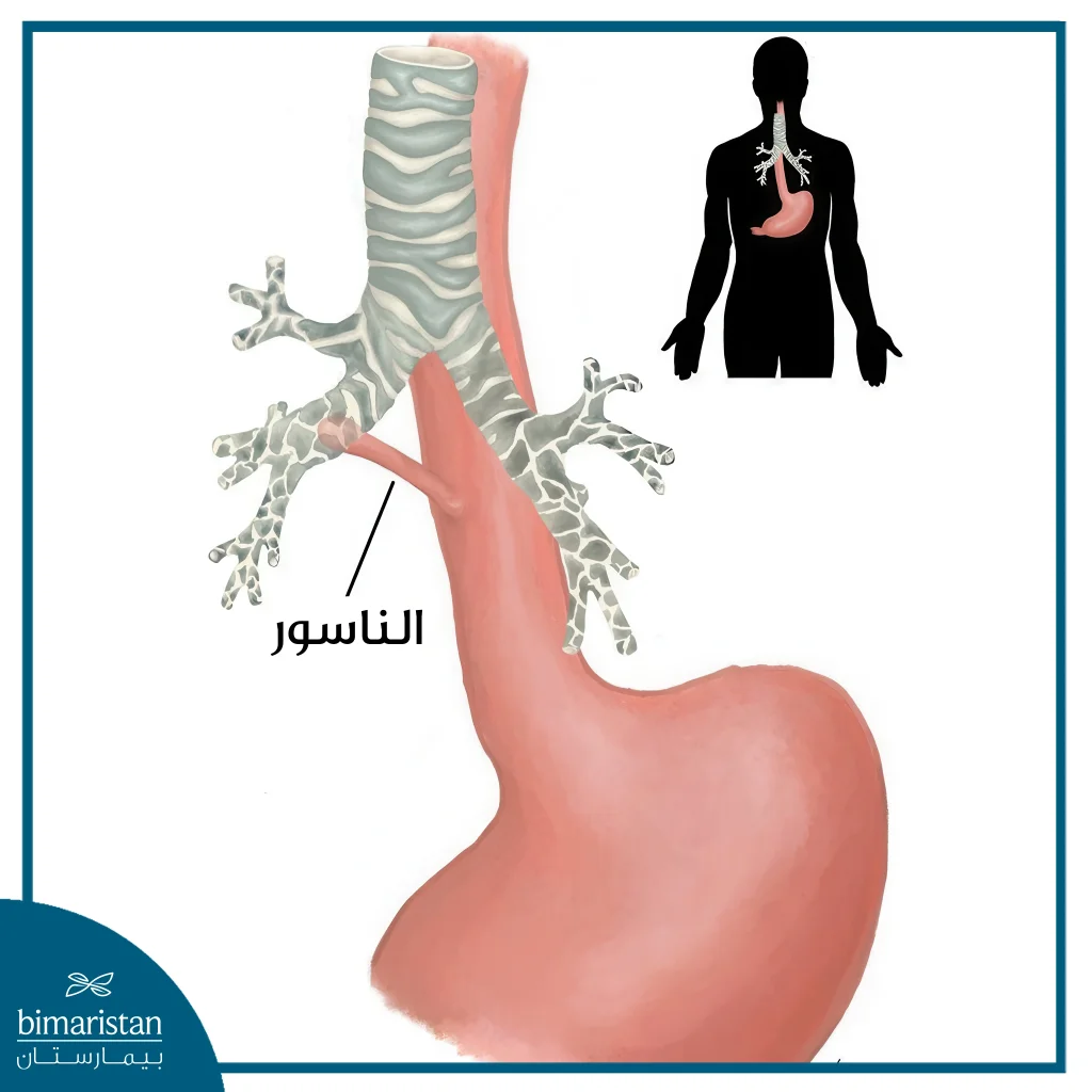 صورة تظهر الناسور المريئي القصبي متصلًا بين المريء والقصبة الهوائية مع وضوح مسار الاتصال المرضي