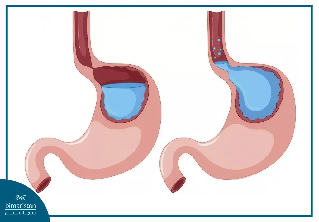 Chronic Gastroesophageal Reflux Disease (Gerd) Leading To Scarring And Narrowing Of The Esophagus