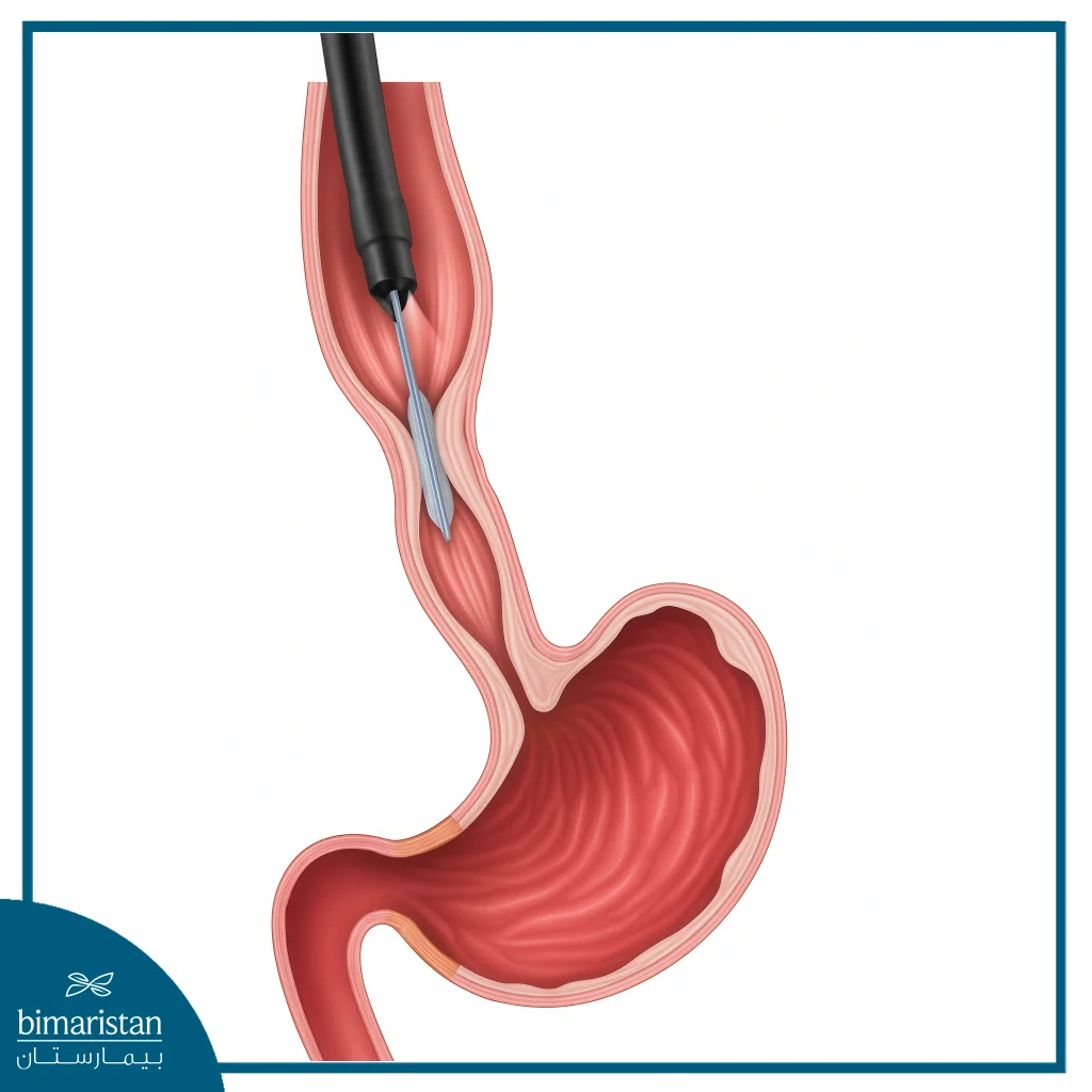 An Image Illustrating How To Access And Dilate The Esophagus Using A Balloon