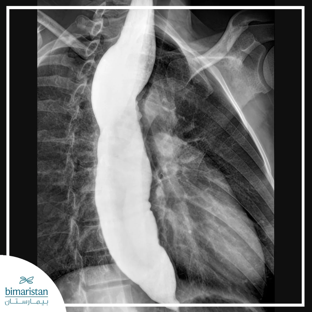 X-Ray Image Showing Clear Narrowing Of The Esophagus