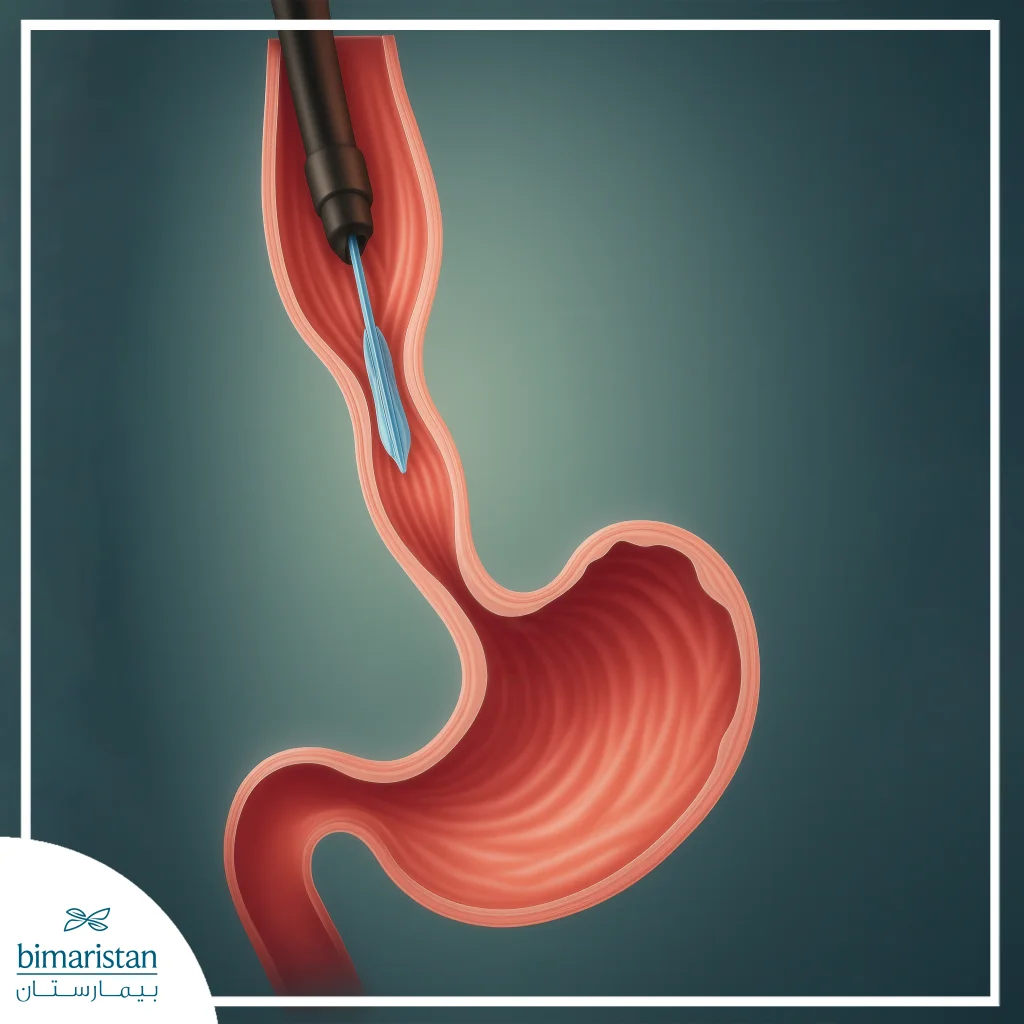 Esophagopaste Is A Procedure Used To Widen Certain Areas Within The Esophagus