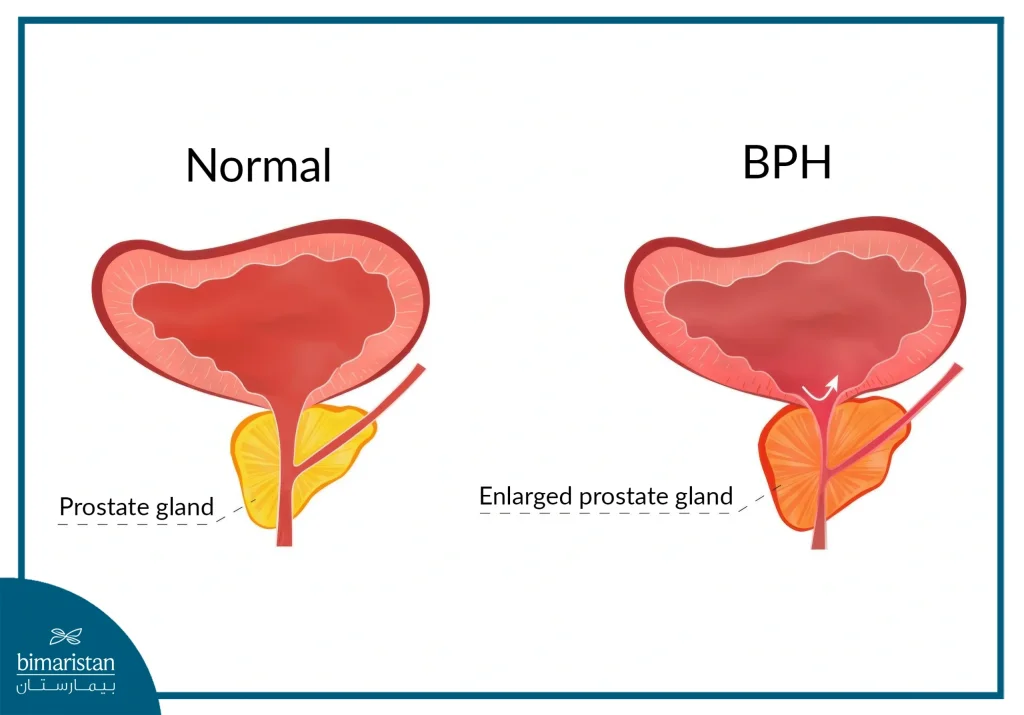 The Difference Between A Healthy Prostate And Benign Prostatic Hyperplasia