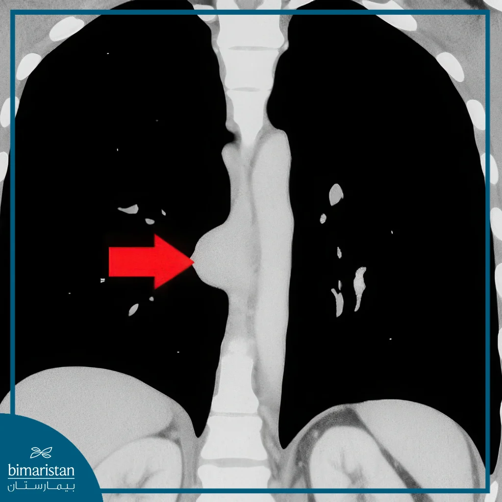 كيسات المريء 2 Eng