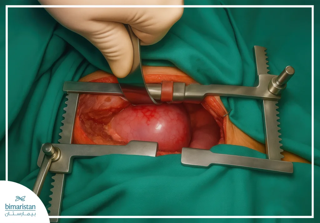 Image Illustrating The Removal Of Esophageal Cysts Using Conventional Surgeryimage Illustrating The Removal Of Esophageal Cysts Using Conventional Surgery