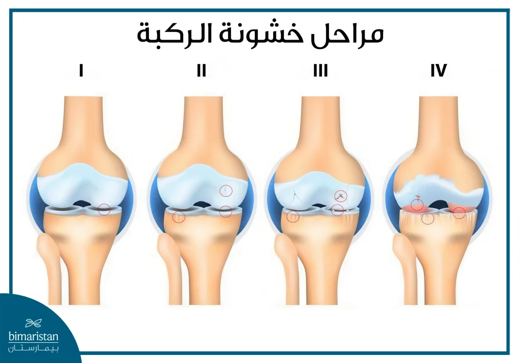 مراحل خشونة الركبة
