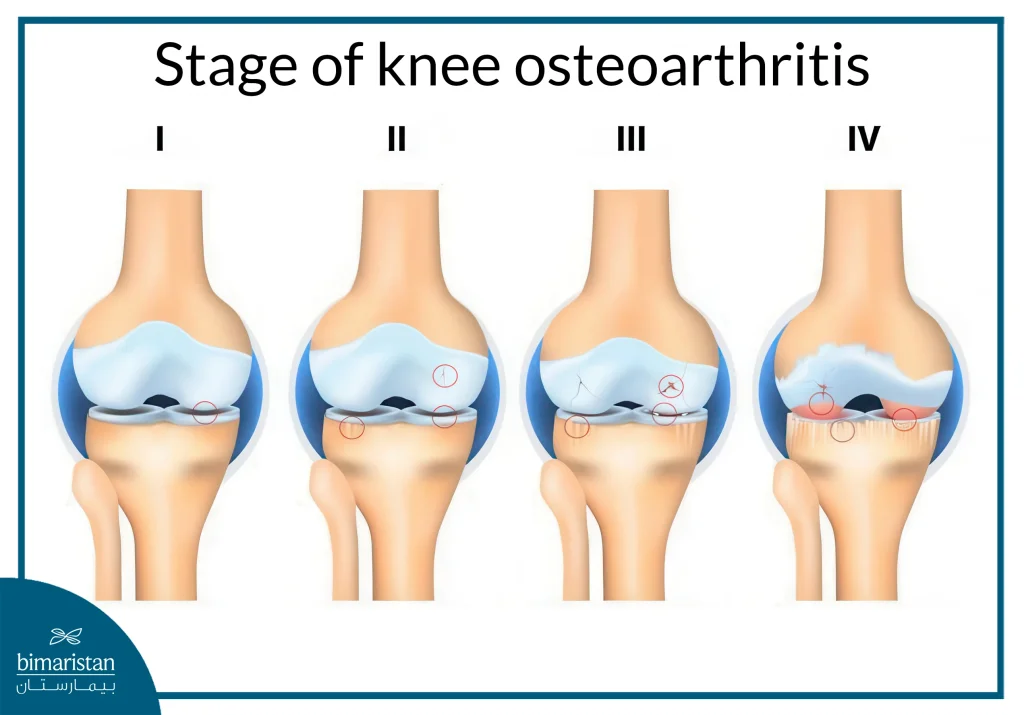 Stages Of Knee Osteoarthritis