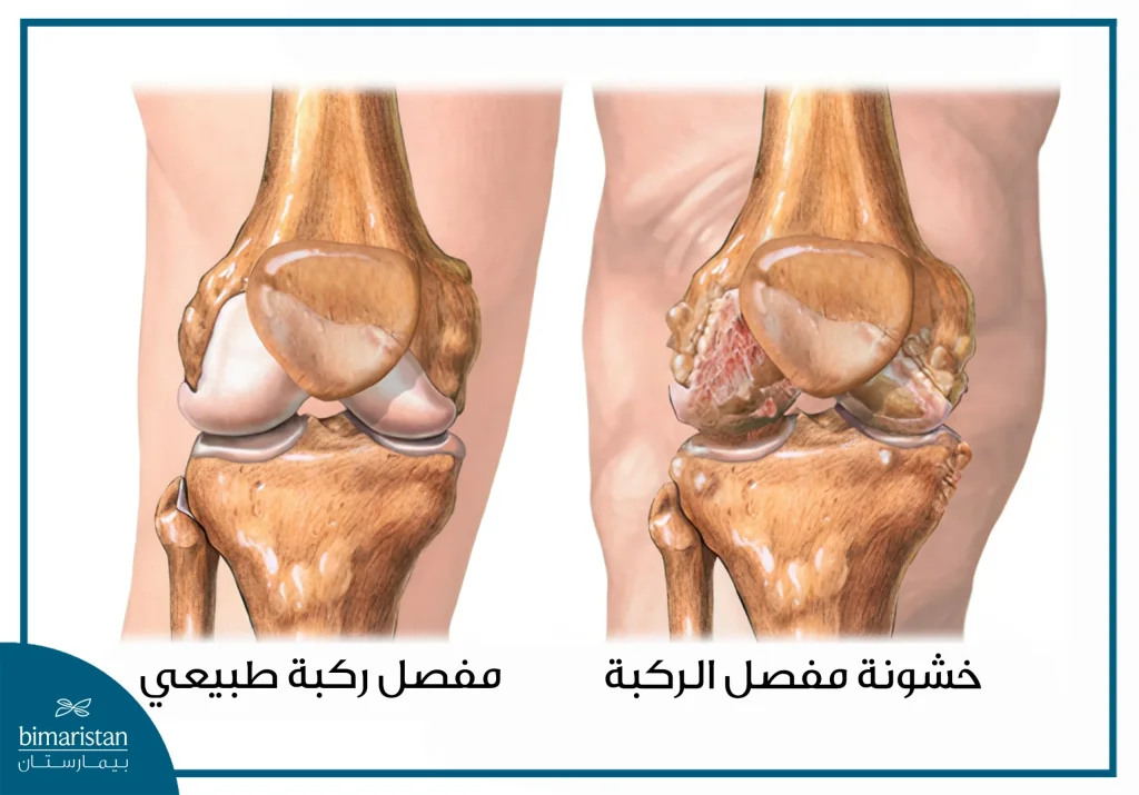 الفرق بين الركبة السليمة والركبة الخشنة